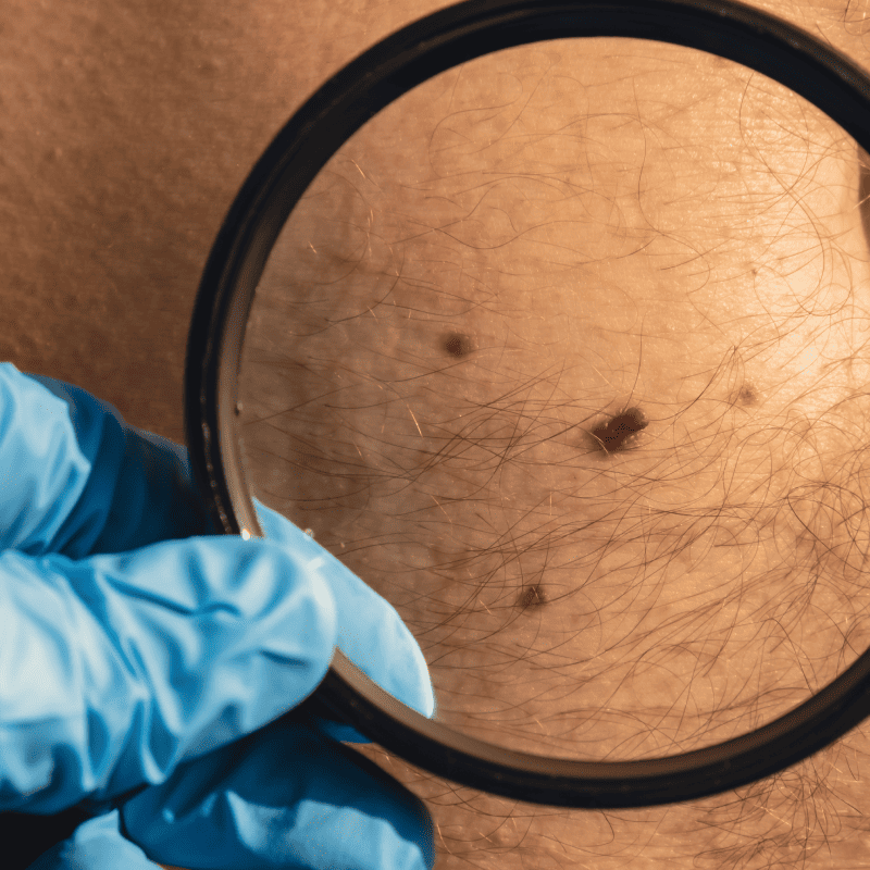 Skin Cancer Screening